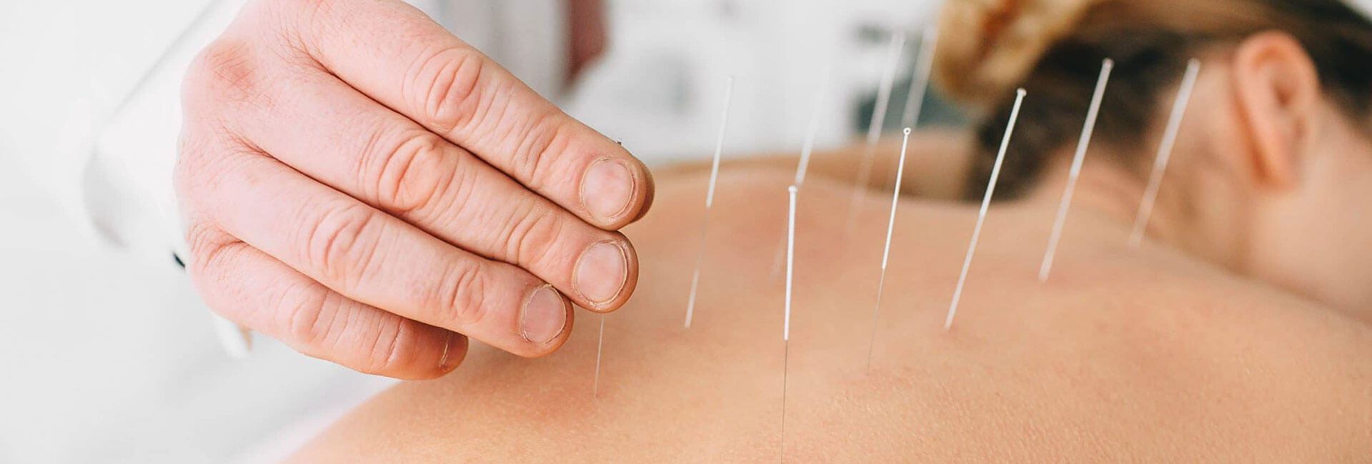 Acupunctures